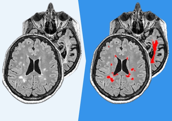 Quantify the impact and degree of inflammation